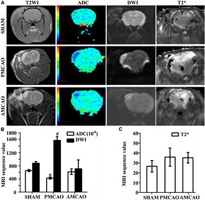 HMG-CoA Reductase Inhibitors Relieve Endoplasmic Reticulum Stress by Autophagy Inhibition in Rats With Permanent Brain Ischemia